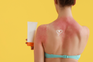 Slnečná alergia: Ako sa prejavuje a ako s ňou bojovať?